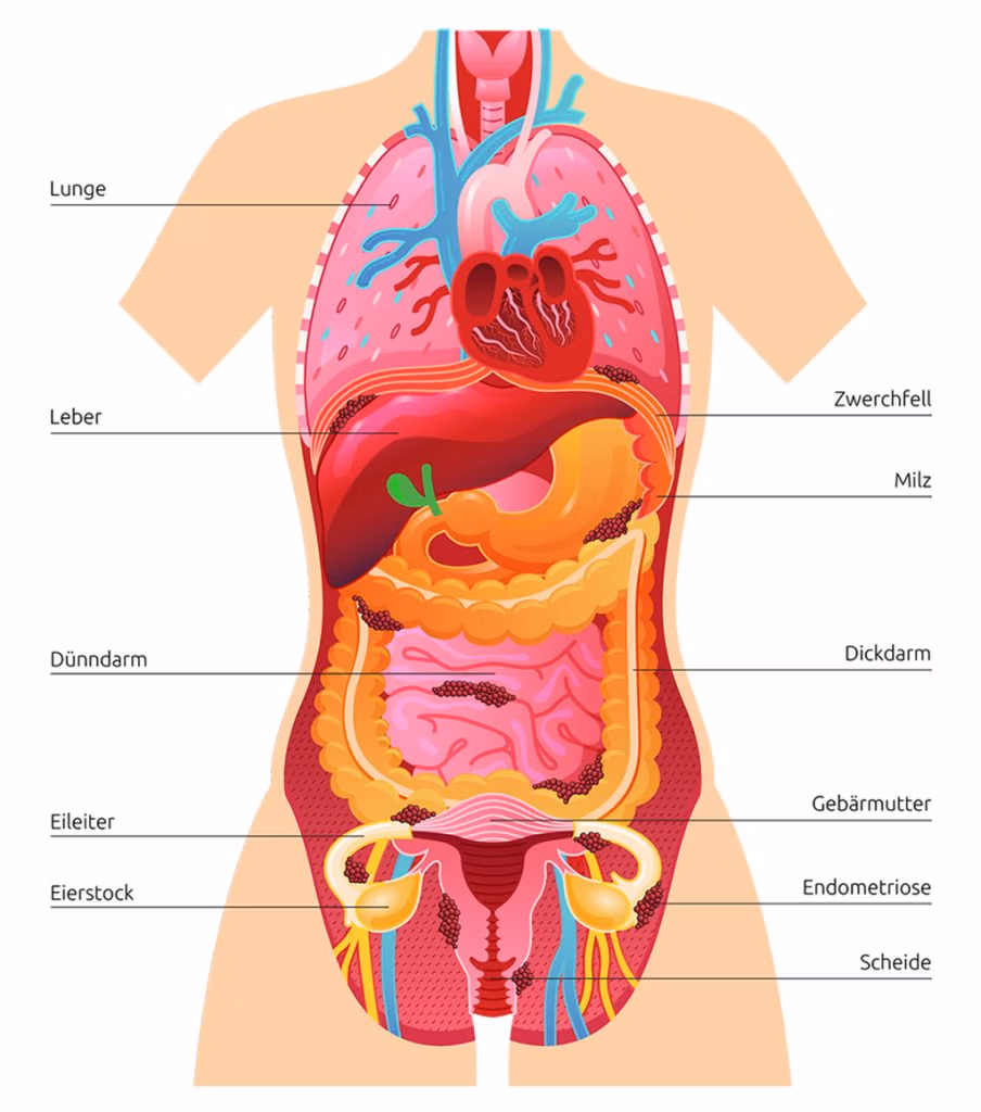 Frontansicht des Körpers mit Endometriose. Markierung von Bauchfell, Eierstöcken, Darm, Blase und weiteren Organen.