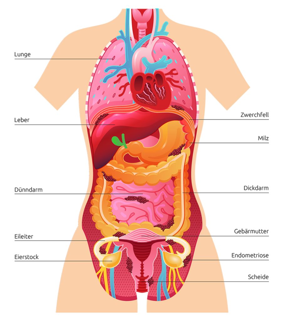 Frontansicht des Körpers mit Endometriose. Markierung von Bauchfell, Eierstöcken, Darm, Blase und weiteren Organen.