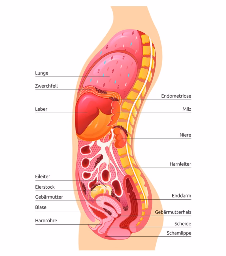 Seitenansicht des Körpers mit Endometriose. Markierung von Bauchfell, Eierstöcken, Darm, Blase und weiteren Organen.