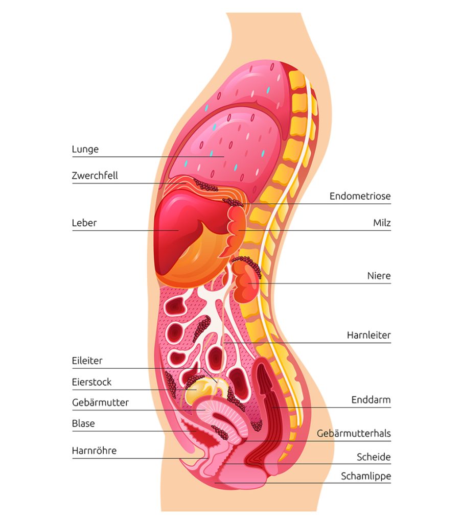 Seitenansicht des Körpers mit Endometriose. Markierung von Bauchfell, Eierstöcken, Darm, Blase und weiteren Organen.