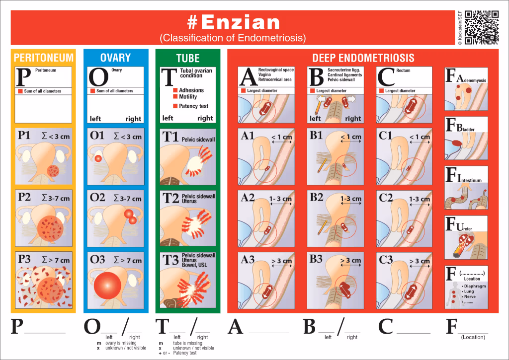 Endometriose Klassifikation Enzian